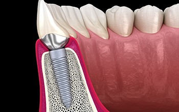 Illustration of a dental implant fused with bone and an abutment holding a crown in place