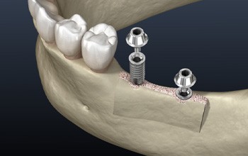 Illustration of two dental implants being placed into the lower jawbone