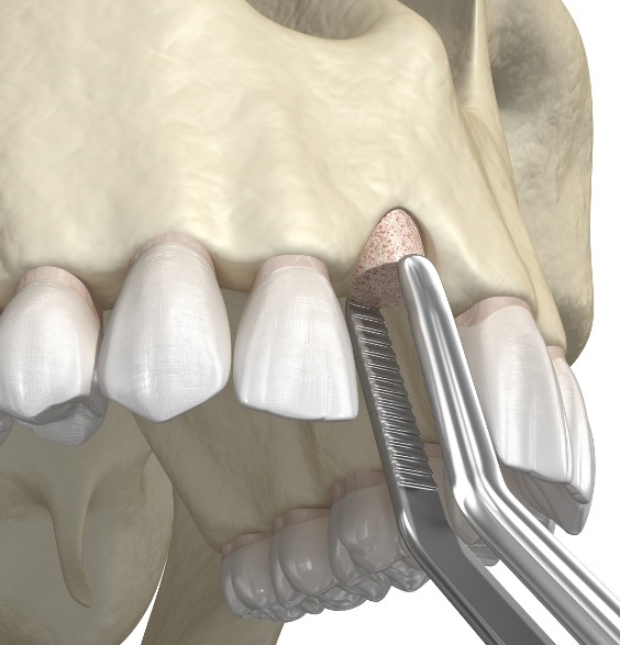 Illustrated bone grafting material being placed in jawbone after tooth extraction