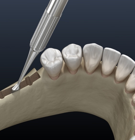 Illustrated dental instruments expanding ridge of lower jawbone