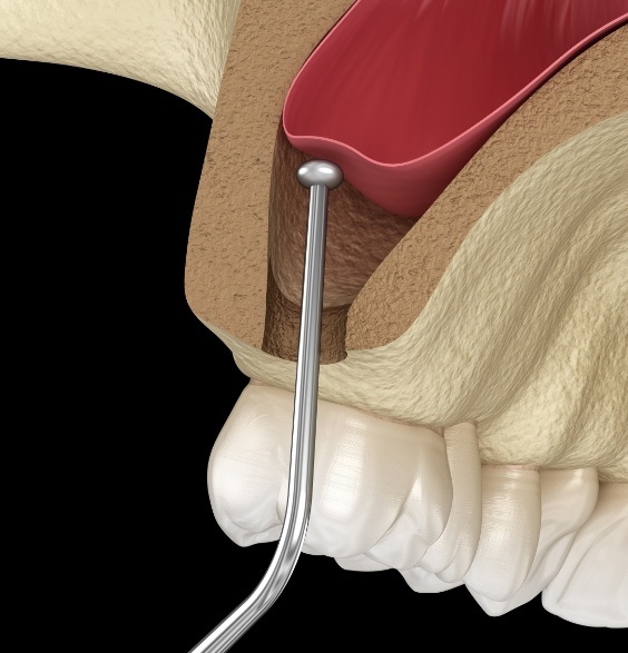 Illustrated dental instrument lifting the sinus membrane