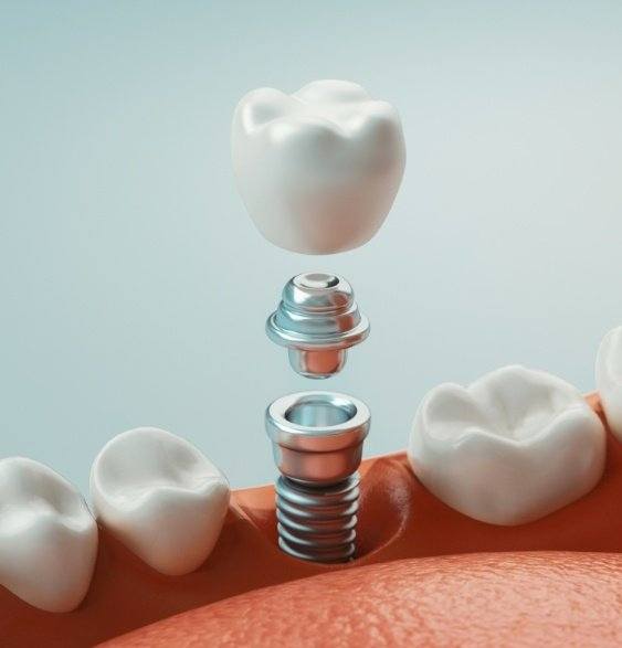 Illustrated dental implant with dental crown replacing a missing lower tooth