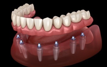 Illustrated full denture being placed over six dental implants