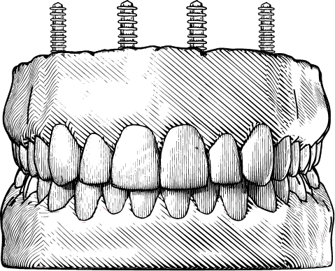 Illustration of an implant denture