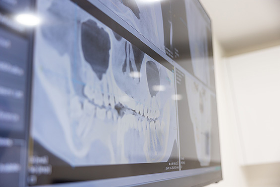 Computer screen showing digital x rays of teeth in Roslyn oral surgery office