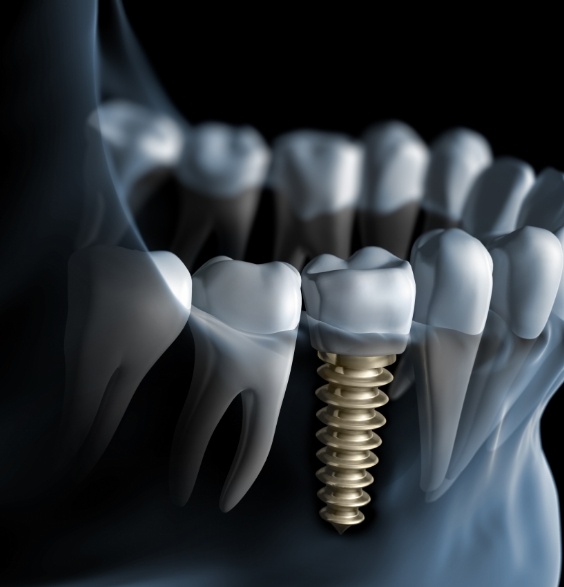 Illustrated x ray of a person with a dental implant