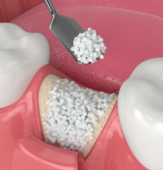 Illustrated bone grafting material being placed in socket after tooth extraction