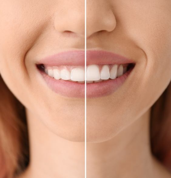Close up of smile before and after treatment with Teeth in a Day