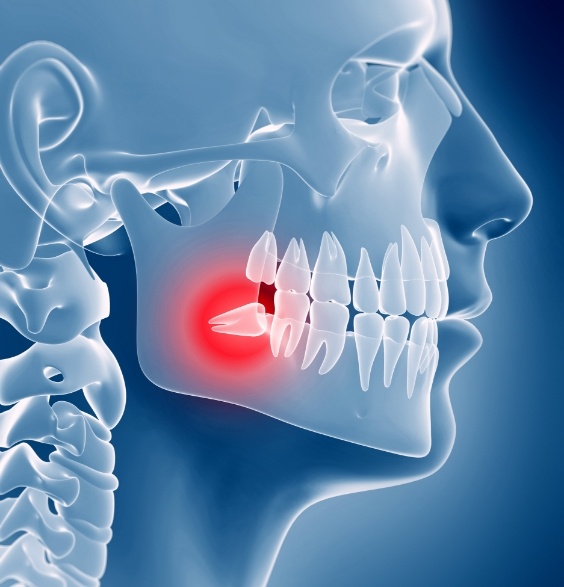 Illustrated x ray showing impacted wisdom tooth pressing against back teeth