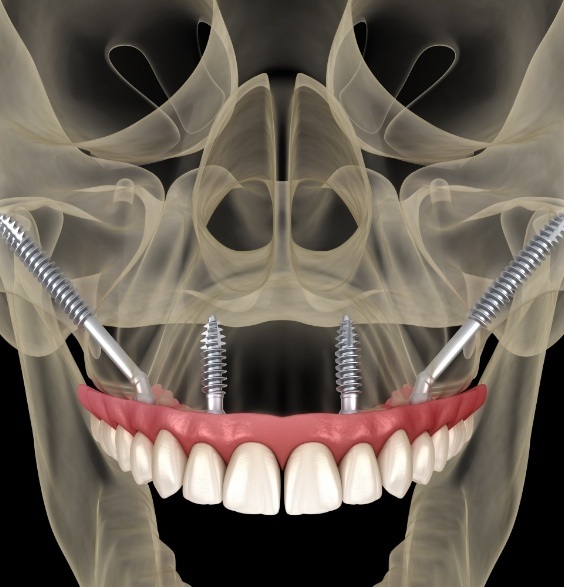 Illustrated x ray of person with zygomatic dental implants in Roslyn in their upper jaw